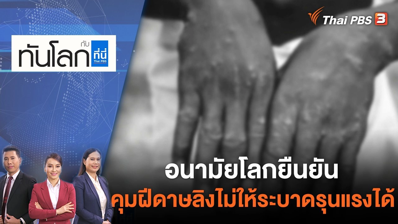 อนามัยโลกยืนยันคุม "ฝีดาษลิง" ไม่ให้ระบาดรุนแรงได้ | ทันโลก กับ ที่นี่ Thai PBS | 24 พ.ค. 65