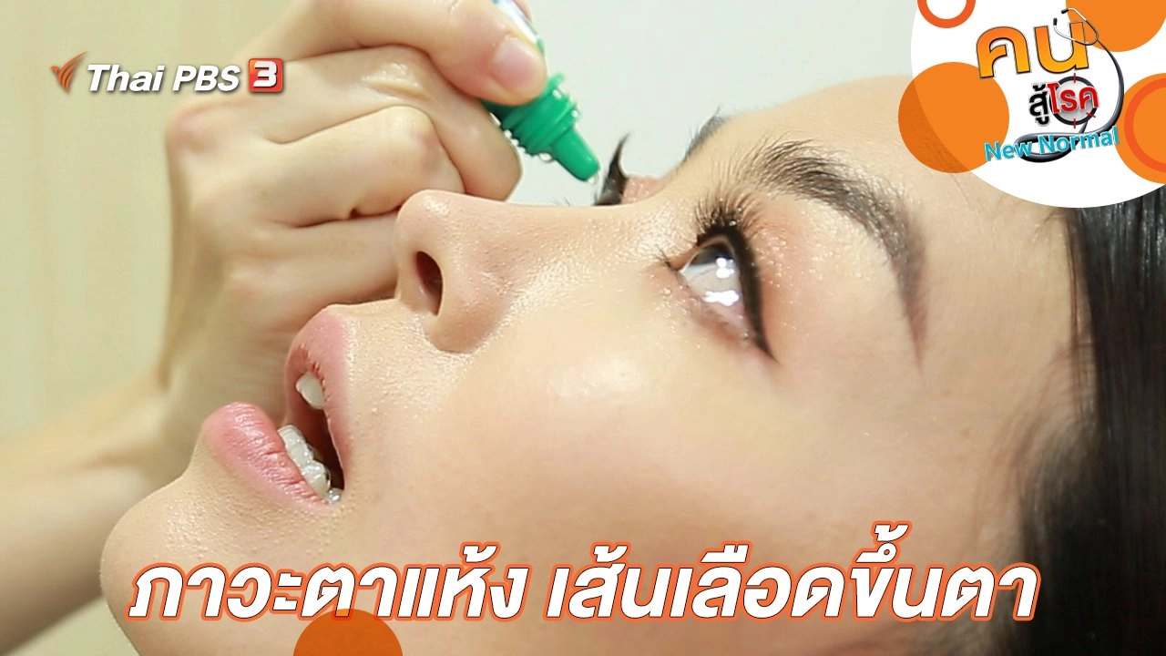 ภาวะตาแห้ง เส้นเลือดขึ้นตา