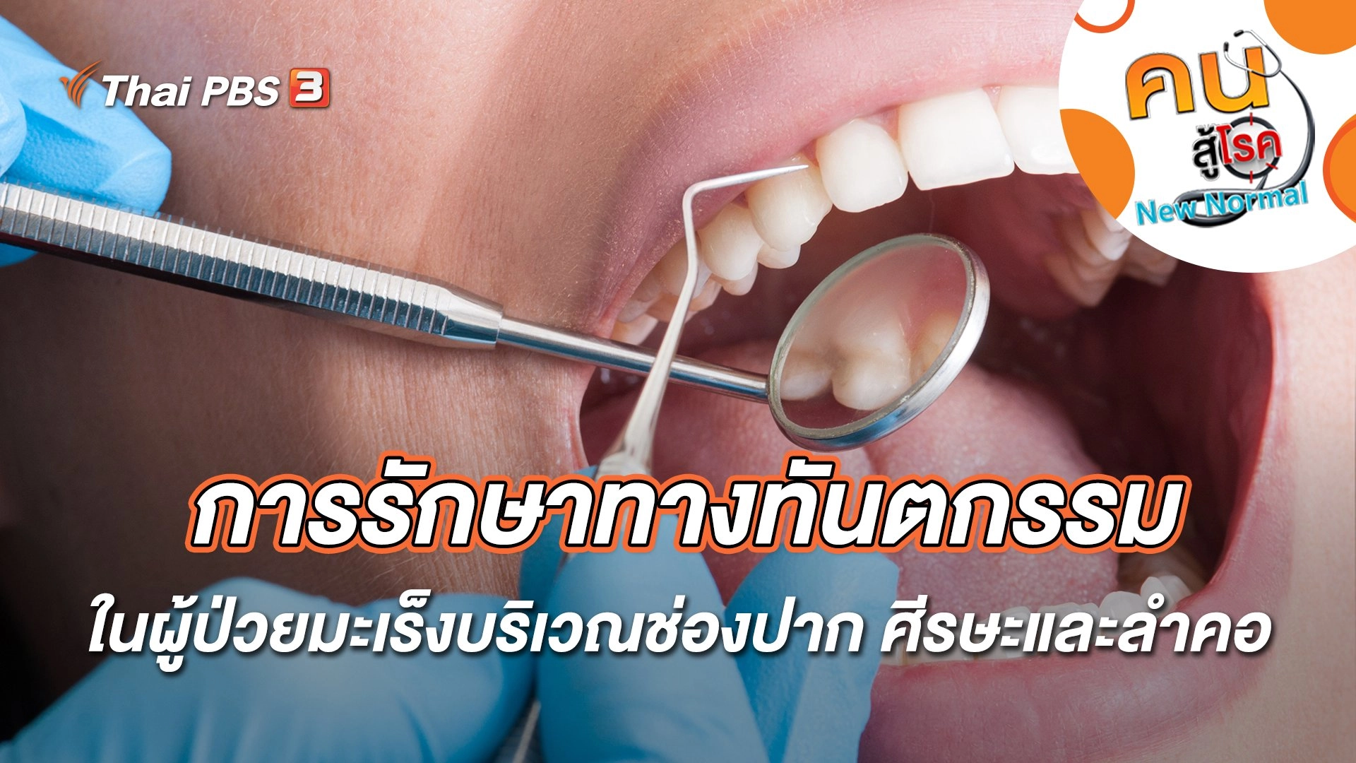 การรักษาทางทันตกรรมในผู้ป่วยมะเร็งบริเวณช่องปาก ศีรษะและลำคอ
