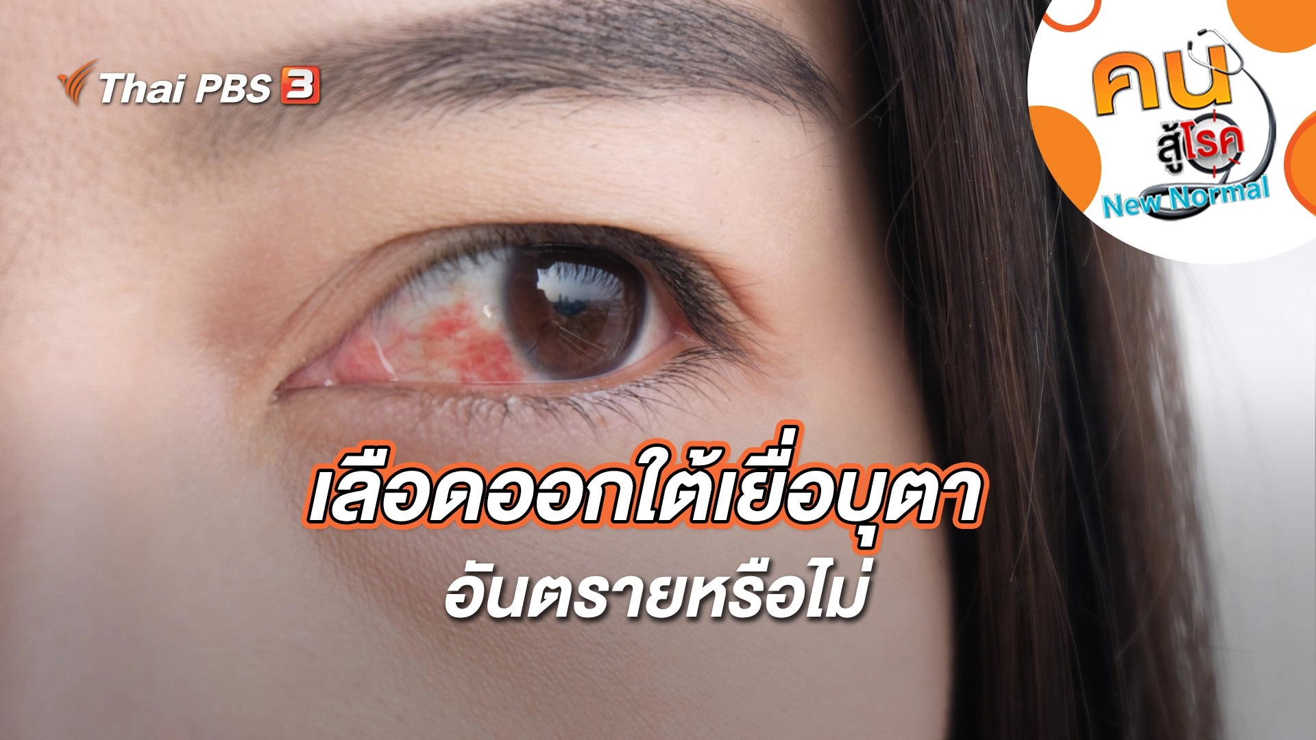 เลือดออกใต้เยื่อบุตาอันตรายหรือไม่