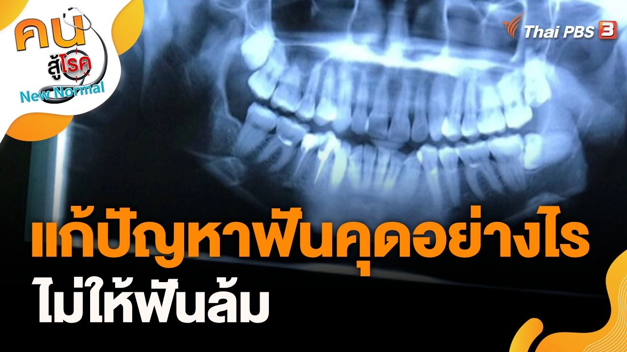 แก้ปัญหาฟันคุดอย่างไรไม่ให้ฟันล้ม