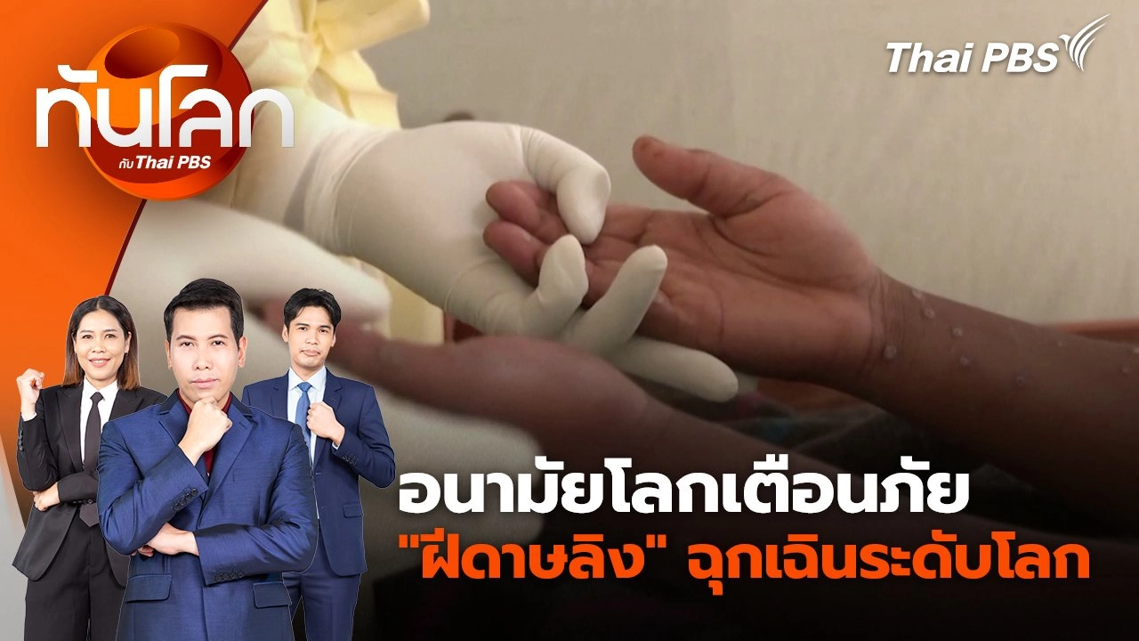 อนามัยโลกเตือนภัย "ฝีดาษลิง" ฉุกเฉินระดับโลก | 15 ส.ค. 67