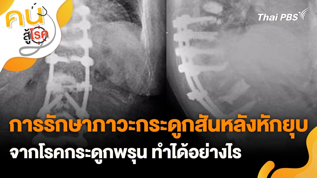 การรักษาภาวะกระดูกสันหลังหักยุบจากโรคกระดูกพรุน ทำได้อย่างไร