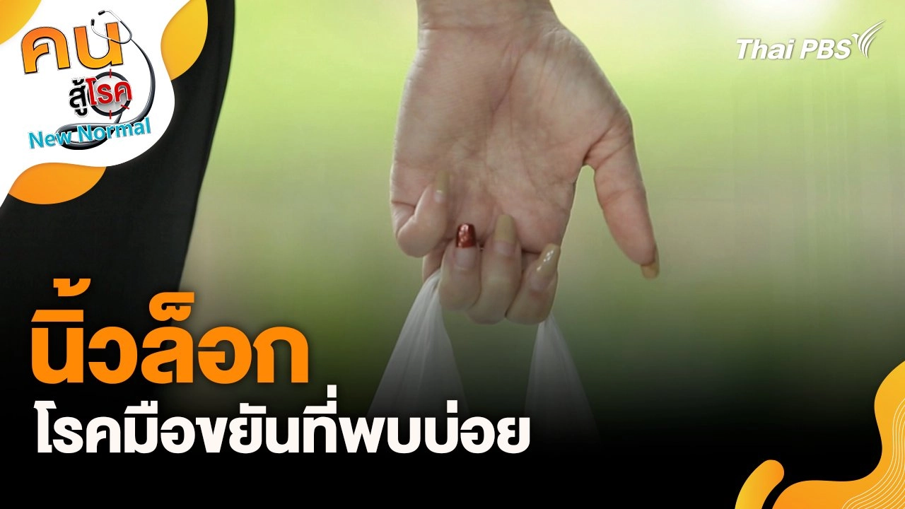 นิ้วล็อกโรคมือขยันที่พบบ่อย