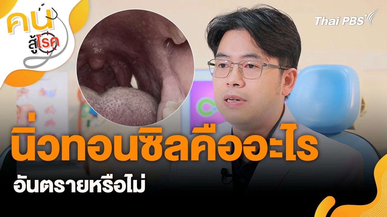 นิ่วทอนซิลคืออะไร อันตรายหรือไม่