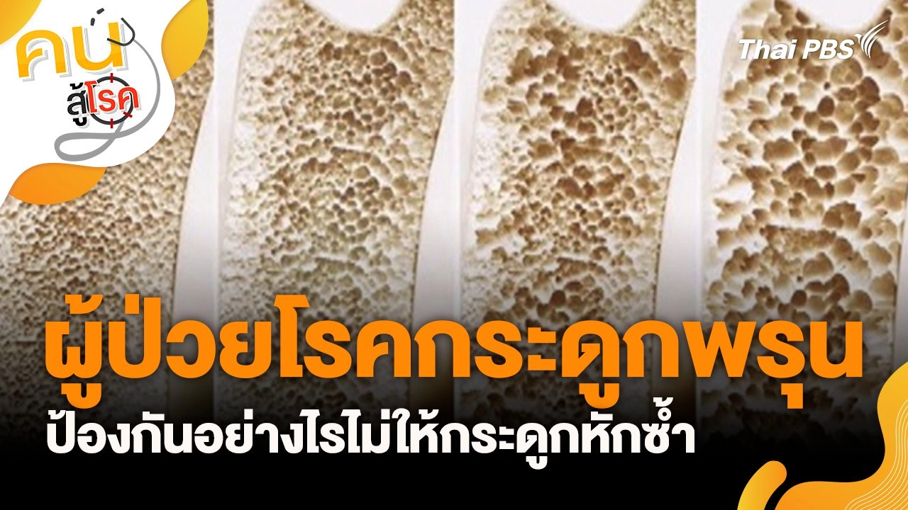 ผู้ป่วยโรคกระดูกพรุน ป้องกันอย่างไรไม่ให้กระดูกหักซ้ำ