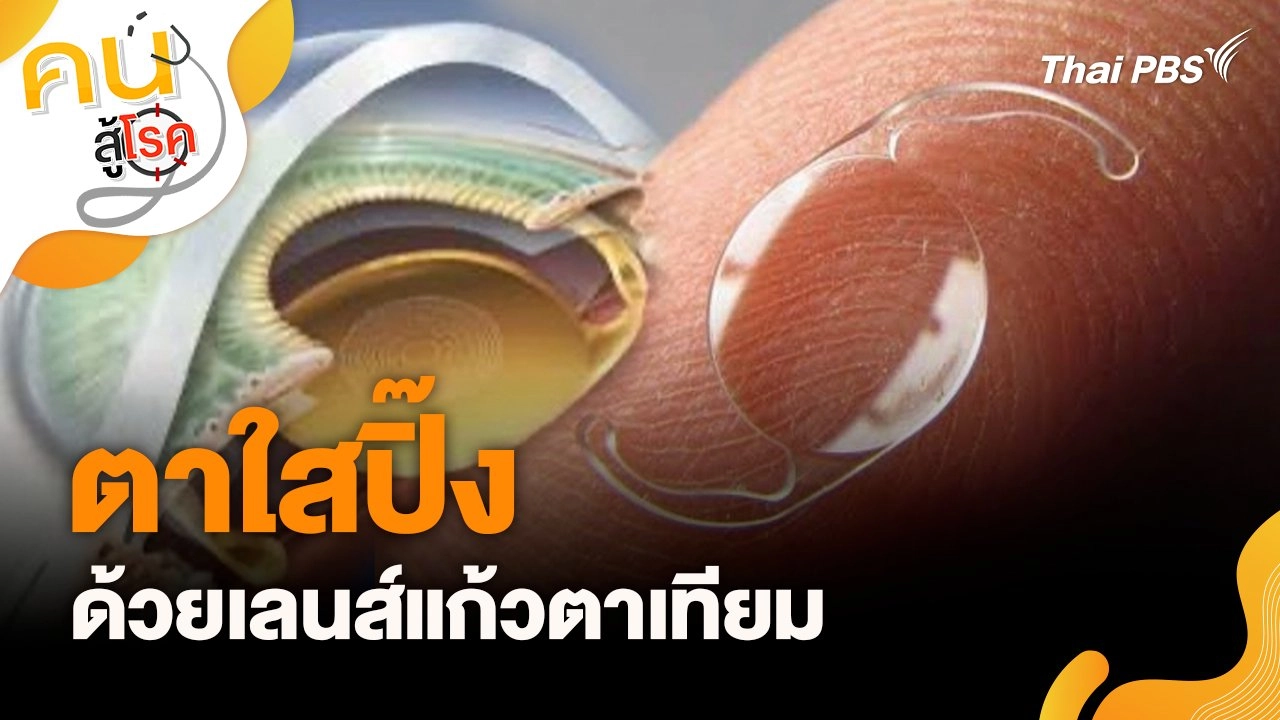 ตาใสปิ๊ง ด้วยเลนส์แก้วตาเทียม
