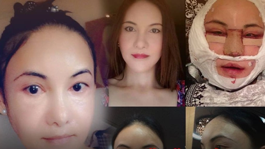 ฟางฟาง ม๊กจ๊ก ร้องทำศัลยกรรมเกาหลีเสียโฉม กระดูกคาง-แก้ม ผิดรูป