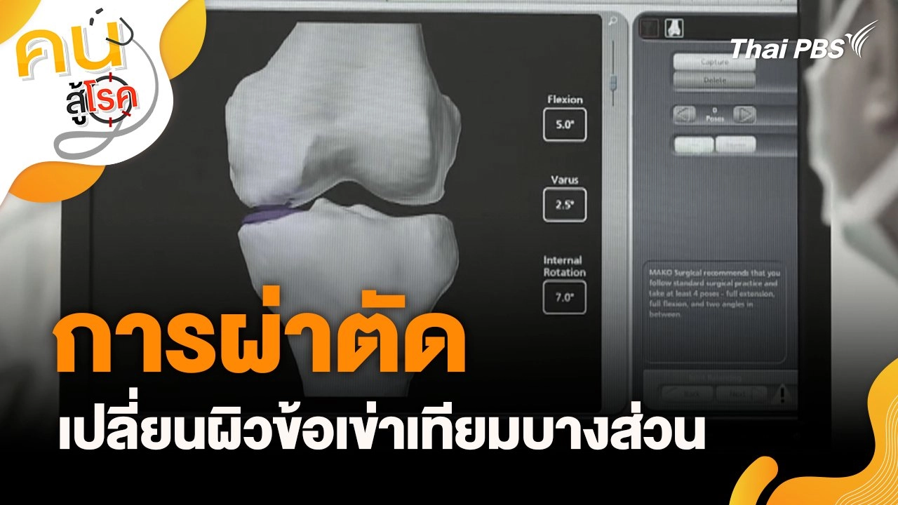 การผ่าตัดเปลี่ยนผิวข้อเข่าเทียมบางส่วน
