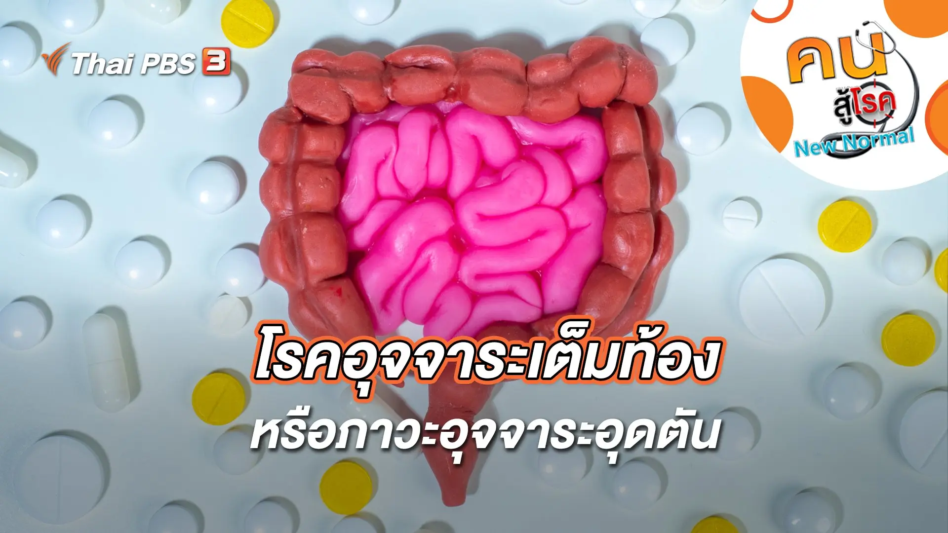 โรคอุจจาระเต็มท้อง หรือภาวะอุจจาระอุดตัน