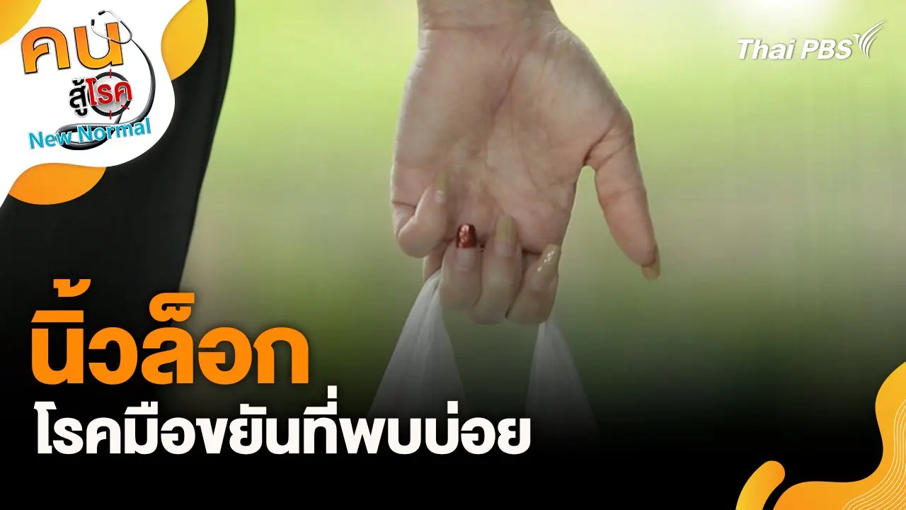 นิ้วล็อกโรคมือขยันที่พบบ่อย
