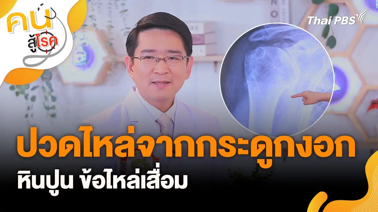 ปวดไหล่จากกระดูกงอก หินปูน ข้อไหล่เสื่อม