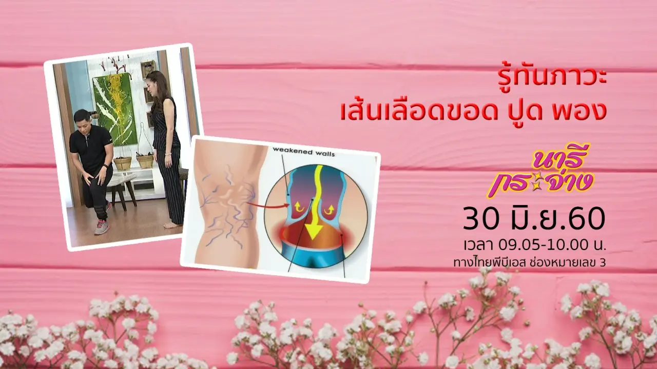 รู้ทันภาวะ "เส้นเลือดขอด-ปูด-พอง"
