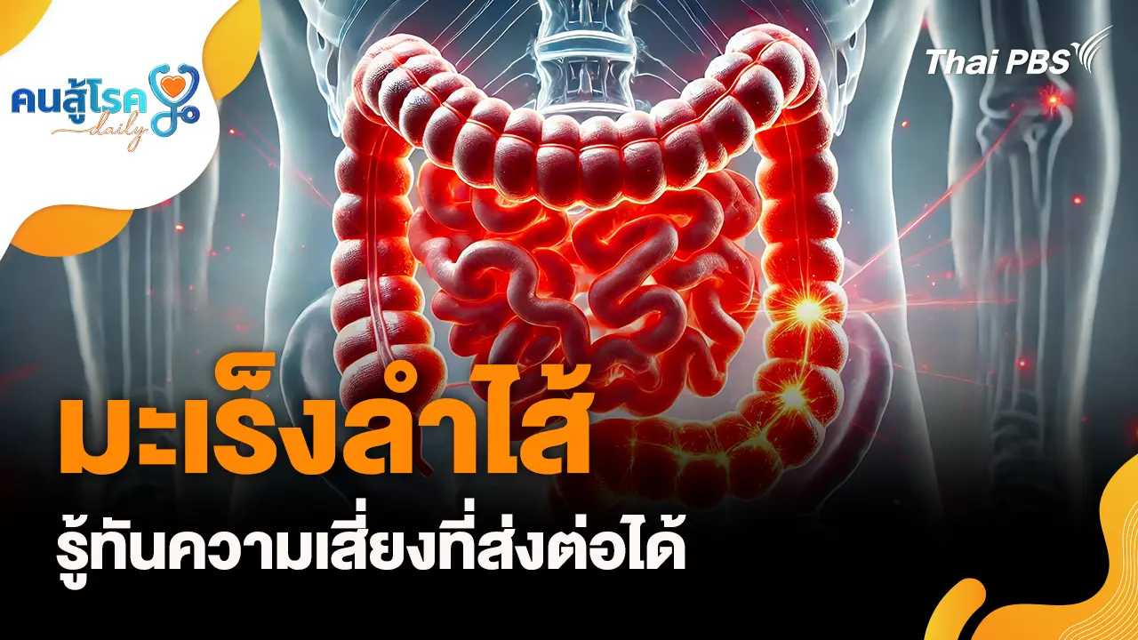 มะเร็งลำไส้ รู้ทันความเสี่ยงที่ส่งต่อได้