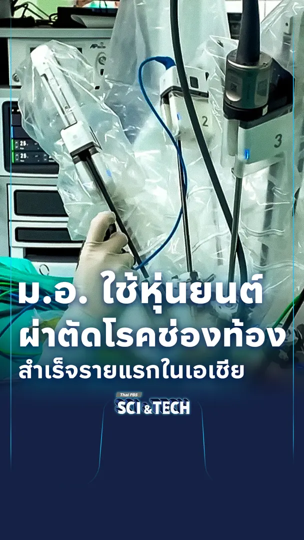 ม.อ. ใช้หุ่นยนต์ผ่าตัดโรคช่องท้องสำเร็จรายแรกในเอเชีย