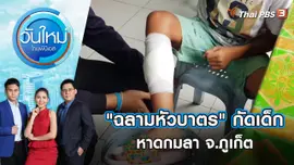 ชี้รอยแผล "ฉลามหัวบาตร" กัดเด็กที่หาดกมลา จ.ภูเก็ต | วันใหม่ ไทยพีบีเอส | 3 พ.ค. 65