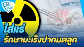 รู้ทันกันได้ : ใส่แร่ รักษามะเร็งปากมดลูก