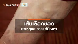 ​รู้สู้โรค : แก้ปัญหาเส้นเลือดขอด