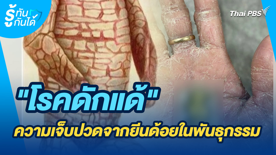 รู้ทันกันได้ : "โรคดักแด้" ความเจ็บปวดจากยีนด้อยในพันธุกรรม