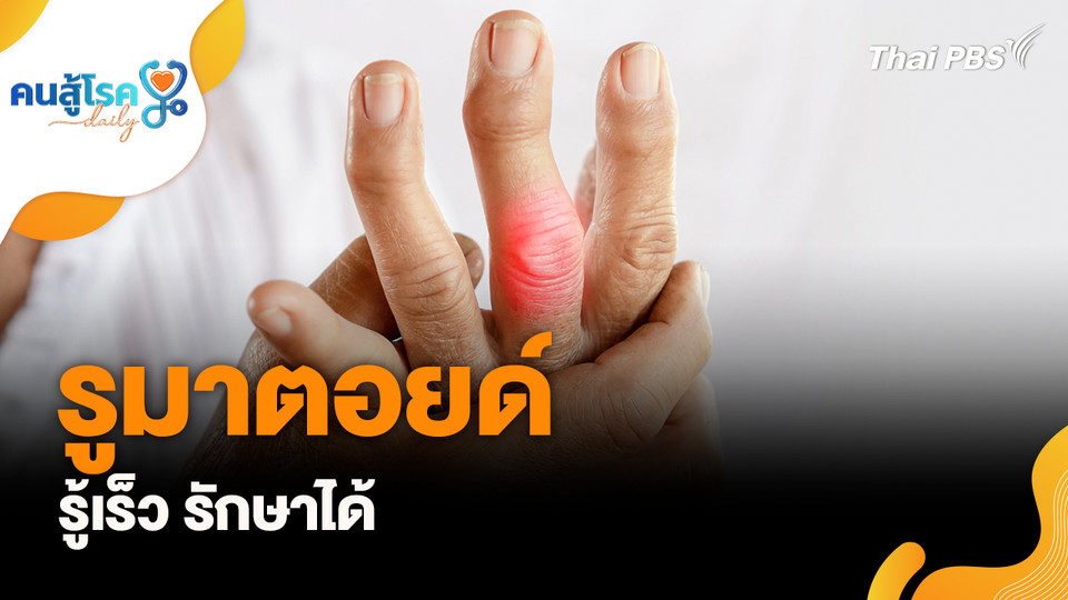 รูมาตอยด์ รู้เร็ว รักษาได้