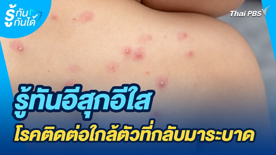 รู้ทันกันได้ : รู้ทันอีสุกอีใส โรคติดต่อใกล้ตัวที่กลับมาระบาด