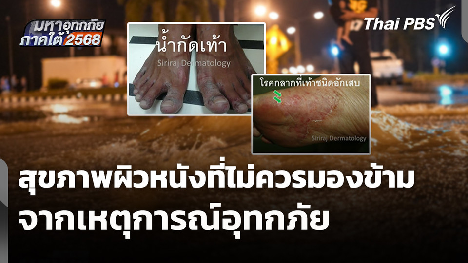สุขภาพผิวหนังที่ไม่ควรมองข้ามจากเหตุการณ์อุทกภัย