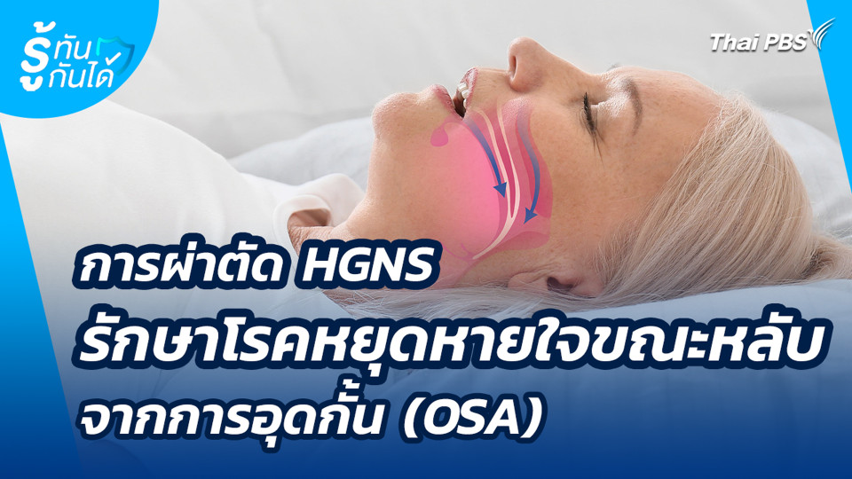 การผ่าตัด HGNS รักษาโรคหยุดหายใจขณะหลับจากการอุดกั้น (OSA)