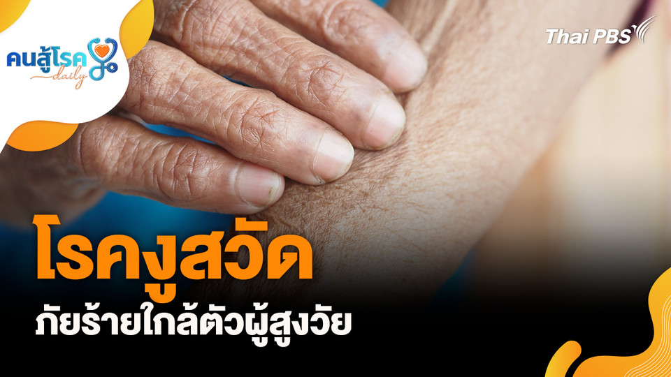 โรคงูสวัดภัยร้ายใกล้ตัวผู้สูงวัย