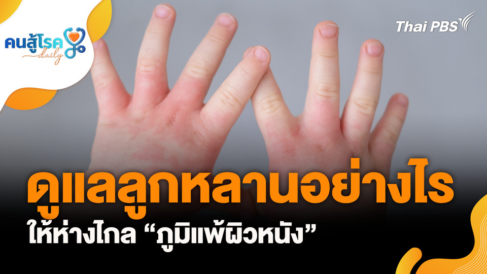 ดูแลลูกหลานอย่างไรให้ห่างไกล “ภูมิแพ้ผิวหนัง”