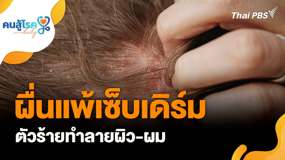 ผื่นแพ้เซ็บเดิร์ม ตัวร้ายทำลายผิว, ดื่มคอลลาเจนทุกวัน สร้างกระดูกอ่อน จริงหรือ ?