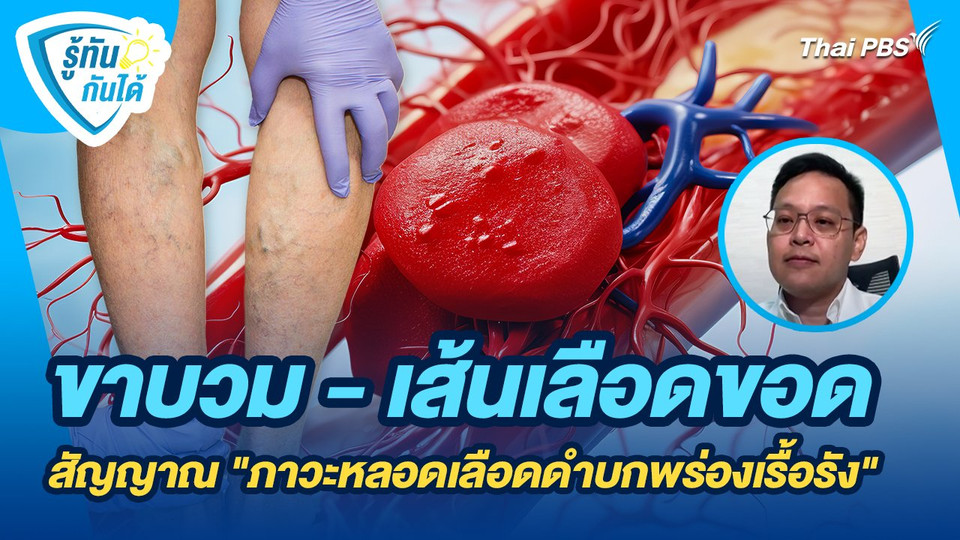 รู้ทันกันได้ : ขาบวม-เส้นเลือดขอด สัญญาณบ่งบอก CVI
