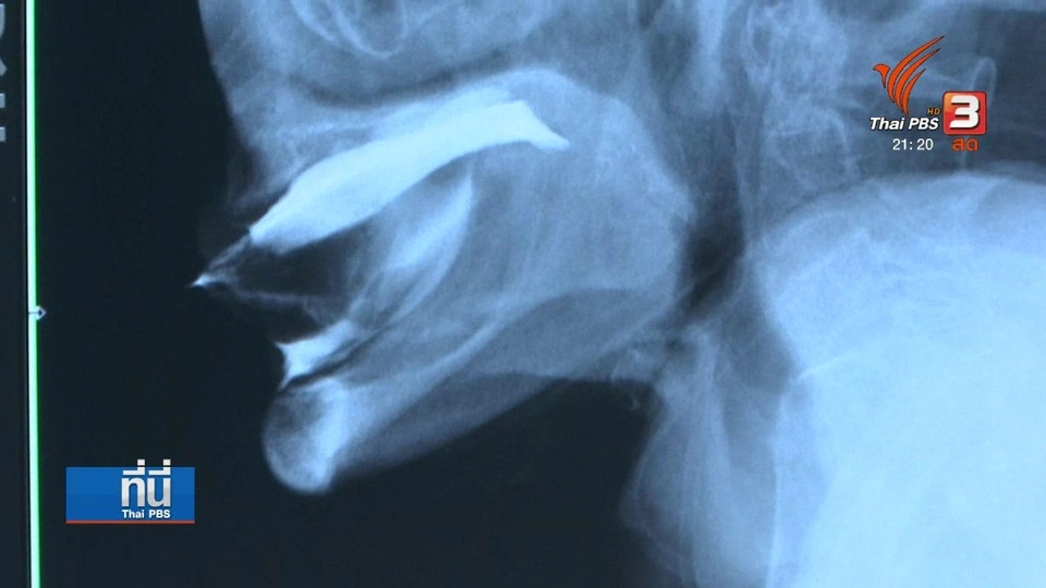 เตือน "สำลักอาหารเเละน้ำ" ในผู้สูงอายุ