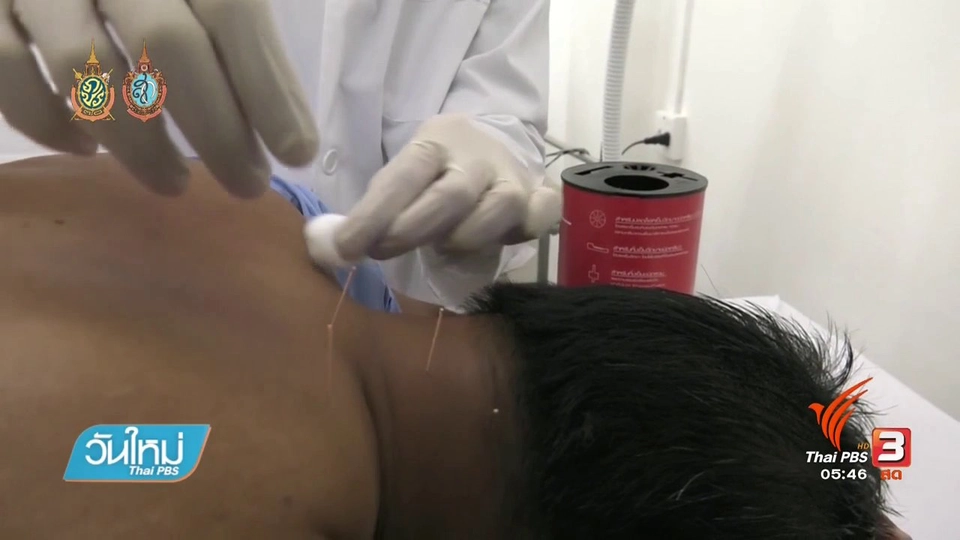 ฝังเข็มรักษาอาการออฟฟิศซินโดรม