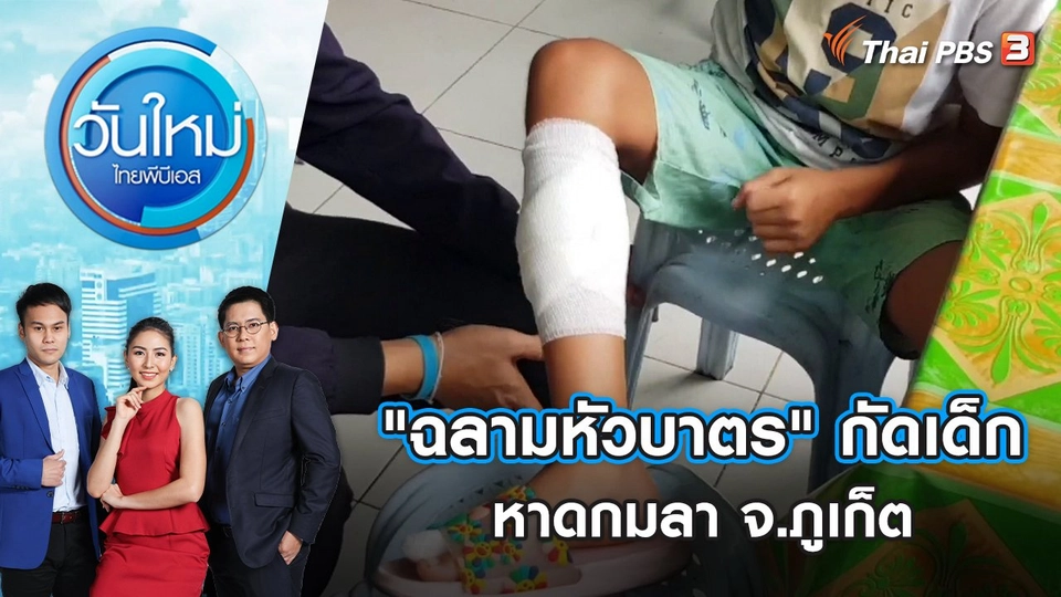 ชี้รอยแผล "ฉลามหัวบาตร" กัดเด็กที่หาดกมลา จ.ภูเก็ต | วันใหม่ ไทยพีบีเอส | 3 พ.ค. 65