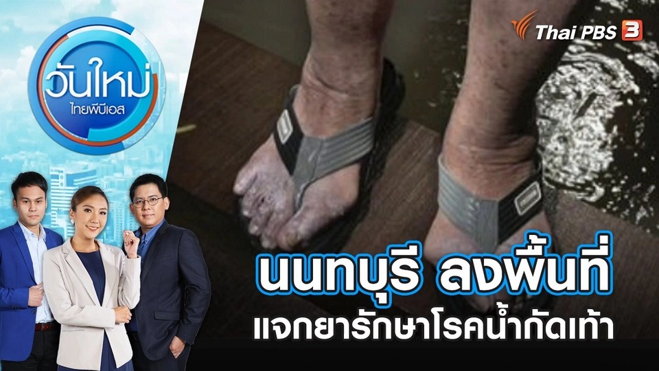 นนทบุรี ลงพื้นที่เเจกยารักษาโรคน้ำกัดเท้า | วันใหม่ ไทยพีบีเอส | 18 ต.ค. 65