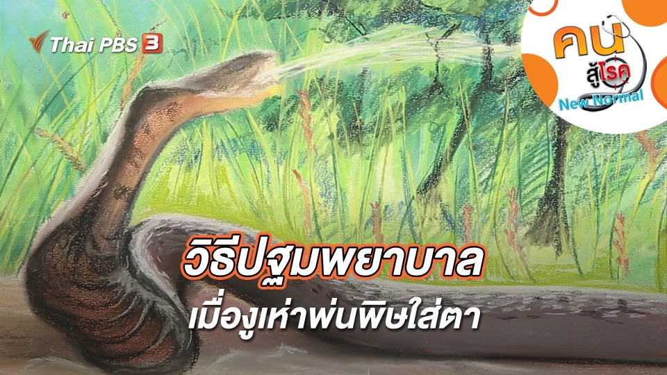 วิธีปฐมพยาบาล เมื่องูเห่าพ่นพิษใส่ตา