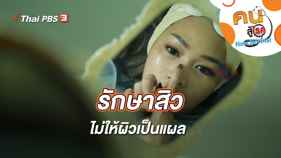 รักษาสิว ไม่ให้ผิวเป็นแผล