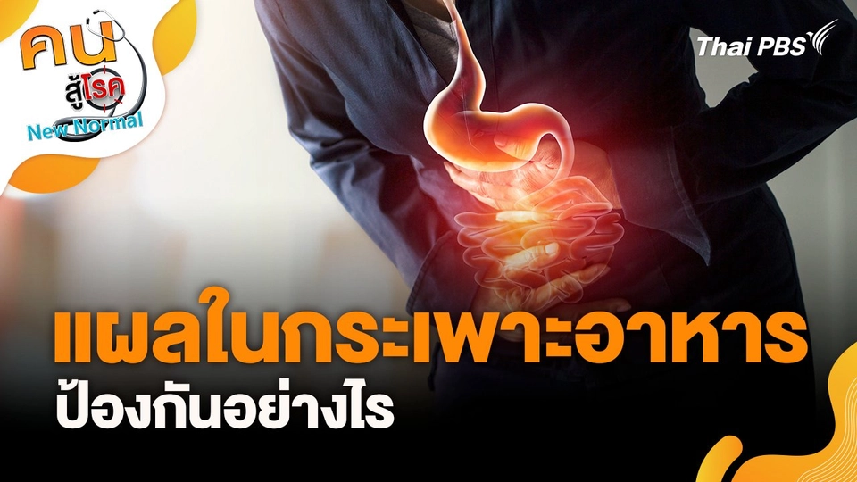 แผลในกระเพาะอาหารป้องกันอย่างไร