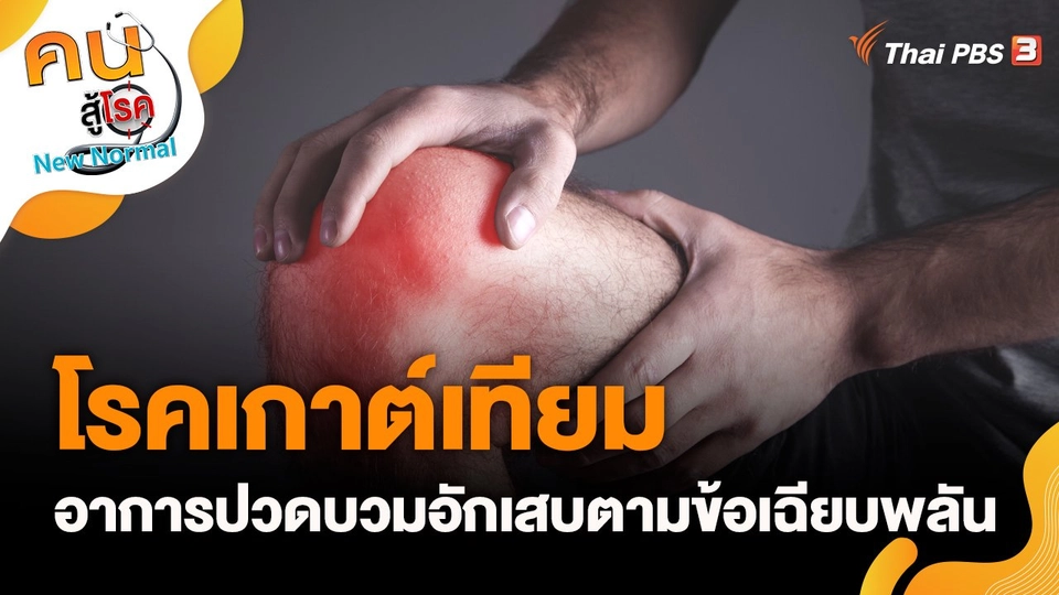 โรคเกาต์เทียม อาการปวดบวมอักเสบตามข้อเฉียบพลัน