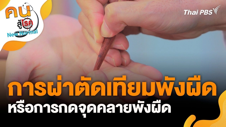 การผ่าตัดเทียมพังผืด