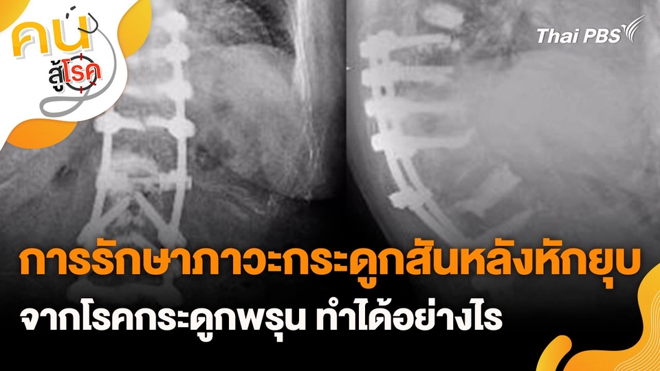 การรักษาภาวะกระดูกสันหลังหักยุบจากโรคกระดูกพรุน ทำได้อย่างไร