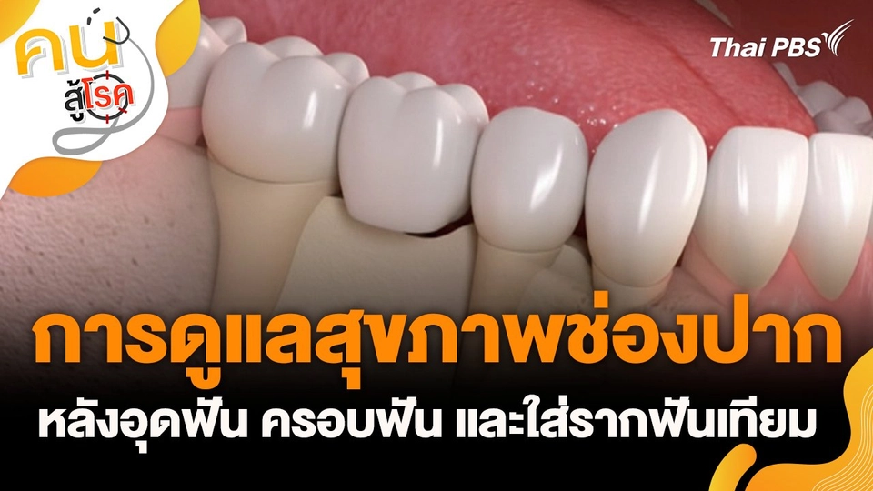 การดูแลสุขภาพช่องปาก หลังอุดฟัน ครอบฟัน และใส่รากฟันเทียม