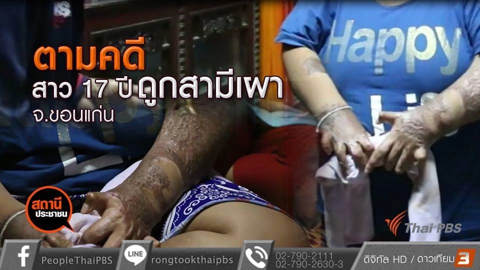 ตามคดีสาว 17 ปี ถูกอดีตสามีจุดไฟเผา จ.ขอนแก่น