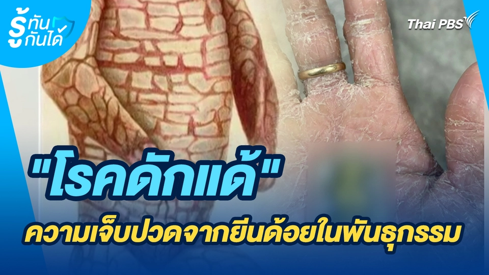 รู้ทันกันได้ : "โรคดักแด้" ความเจ็บปวดจากยีนด้อยในพันธุกรรม