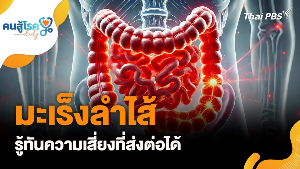 มะเร็งลำไส้ รู้ทันความเสี่ยงที่ส่งต่อได้