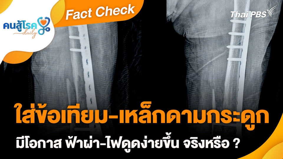 Fact Check : ใส่ข้อเทียม-เหล็กดามกระดูก มีโอกาส ฟ้าผ่า-ไฟดูดง่ายขึ้น จริงหรือ ?