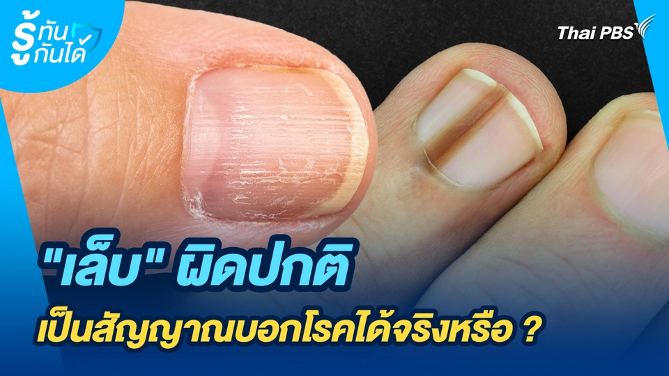 รู้ทันกันได้ : "เล็บ" ผิดปกติเป็นสัญญาณบอกโรคได้จริงหรือ ?