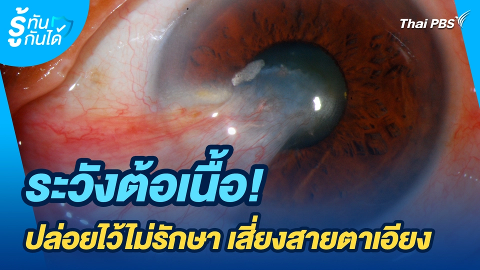รู้ทันกันได้ : ระวังต้อเนื้อ! ปล่อยไว้ไม่รักษา เสี่ยงสายตาเอียง