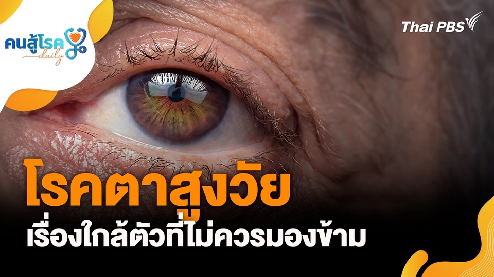 โรคตาสูงวัย เรื่องใกล้ตัวที่ไม่ควรมองข้าม