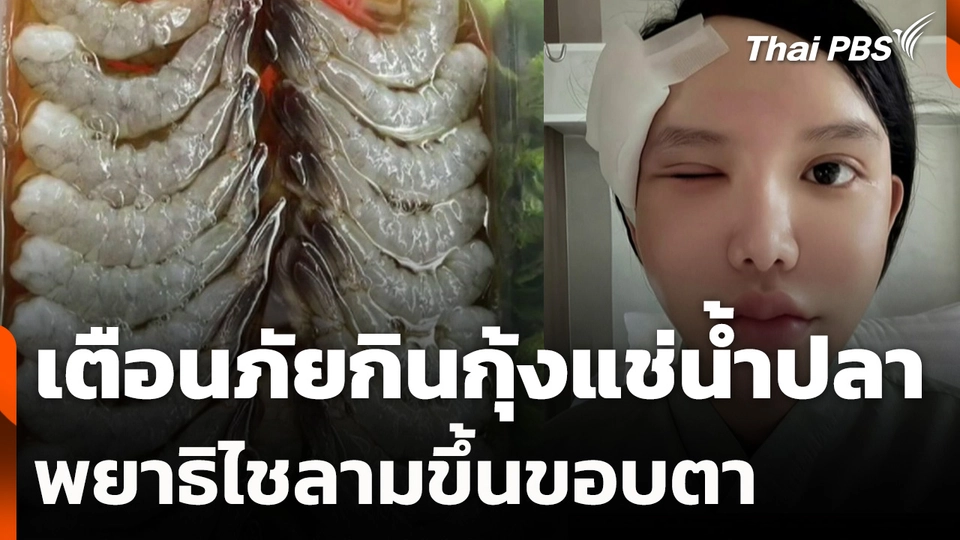 เตือนภัยกินกุ้งแช่น้ำปลา พยาธิไชลามขึ้นขอบตา